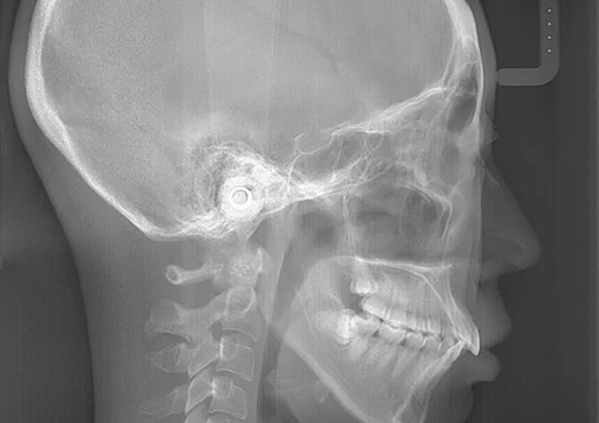 頭部X線規格写真（セファログラム）