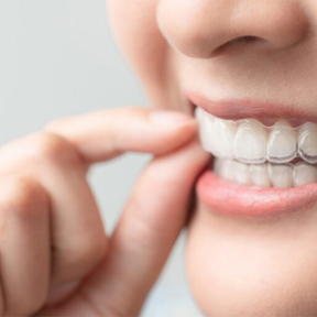 矯正装置の装着