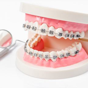 矯正装置の装着