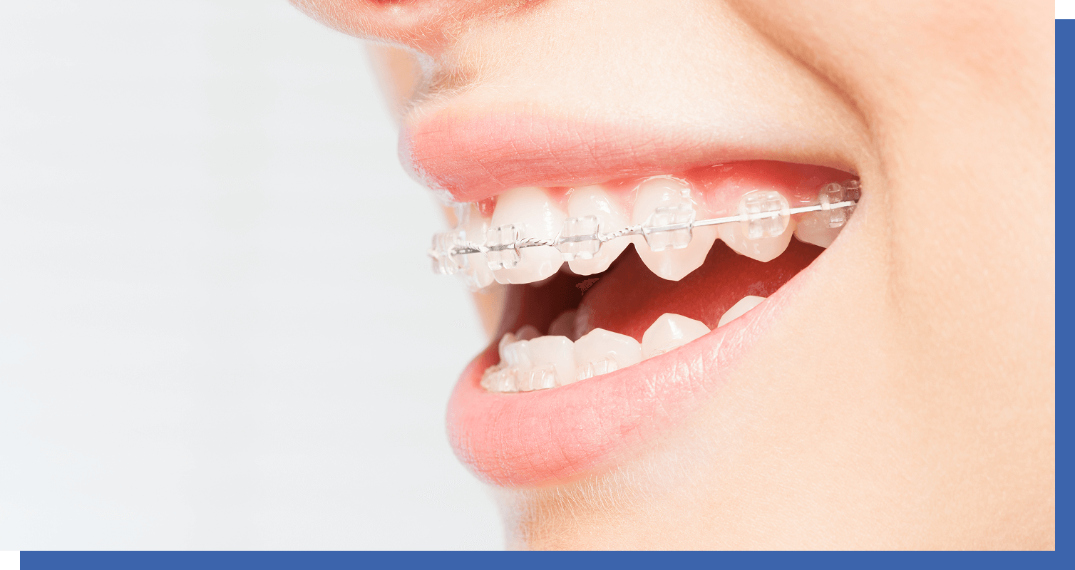 「ゴムメタルワイヤー」を使って非抜歯・痛み軽減・治療期間短縮