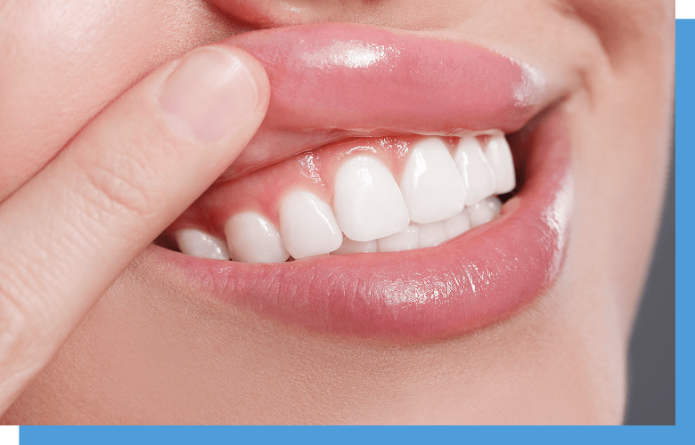 矯正治療後の歯茎下がりにも対応可能