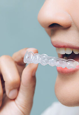 マウスピース矯正