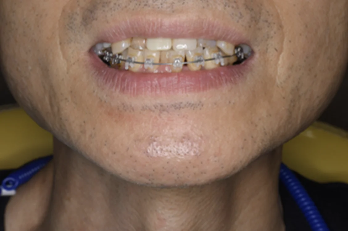 【インプラント・ワイヤー矯正治療】しっかり噛めるようになりたい