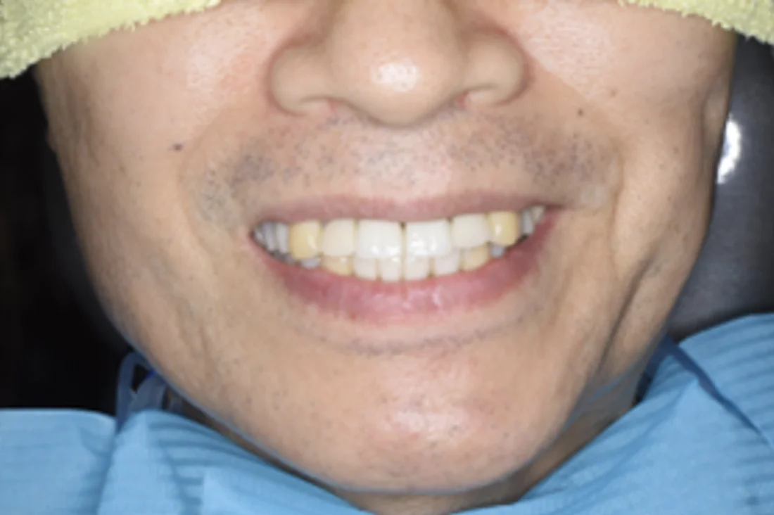 【インプラント・ワイヤー矯正治療】しっかり噛めるようになりたい