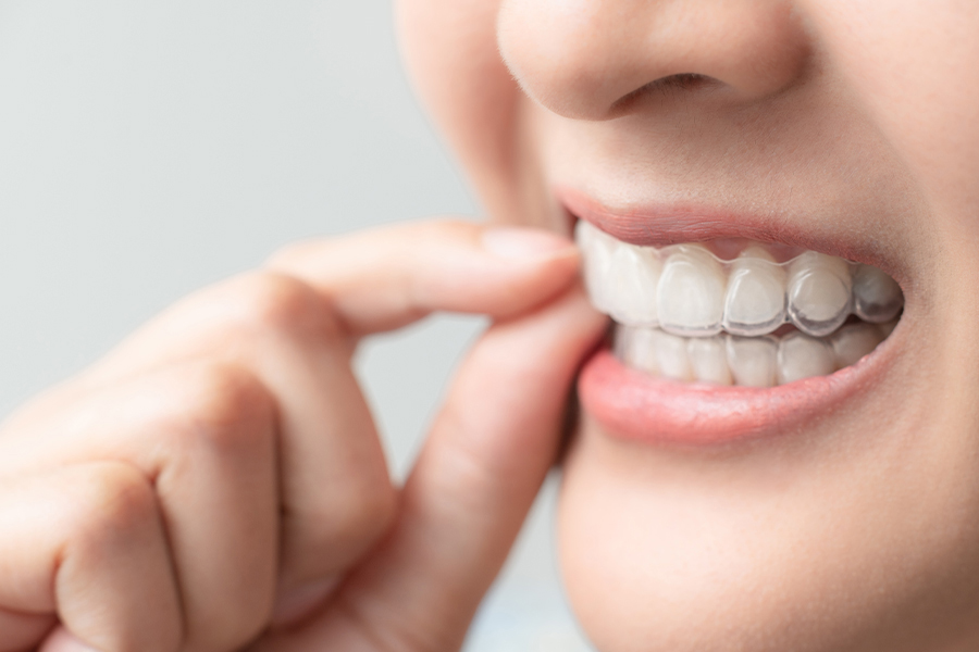 矯正装置の装着