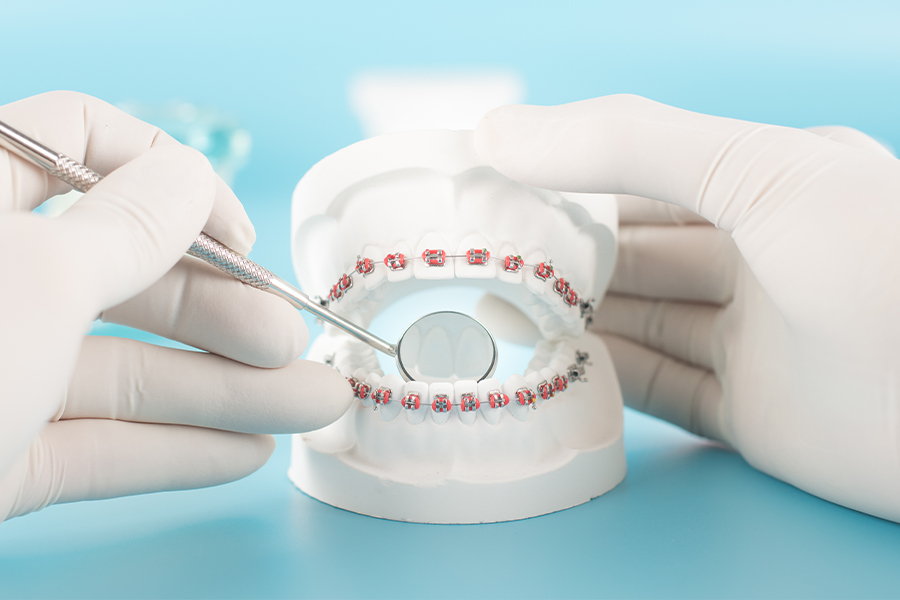 ワイヤー矯正について