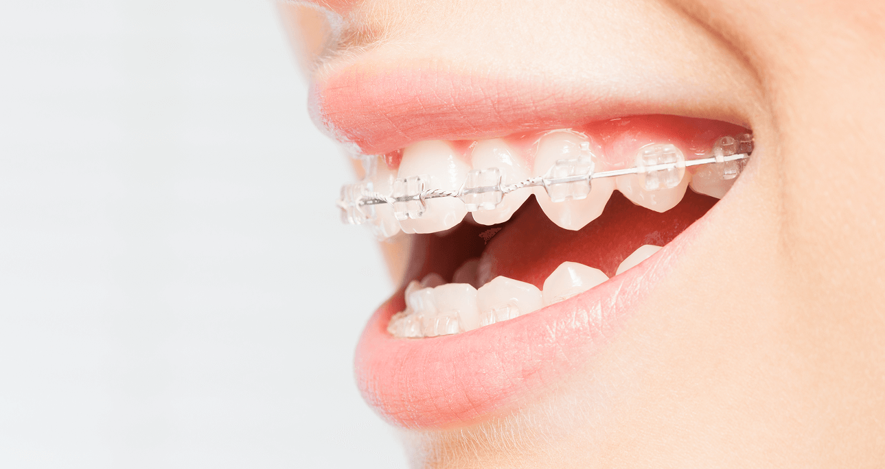 「ゴムメタルワイヤー」を使って非抜歯・痛み軽減・治療期間短縮