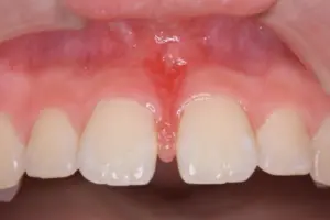 【小児矯正・マウスピース矯正】見た目が気になっている。上の前歯は歯ブラシが当たると少し痛い。