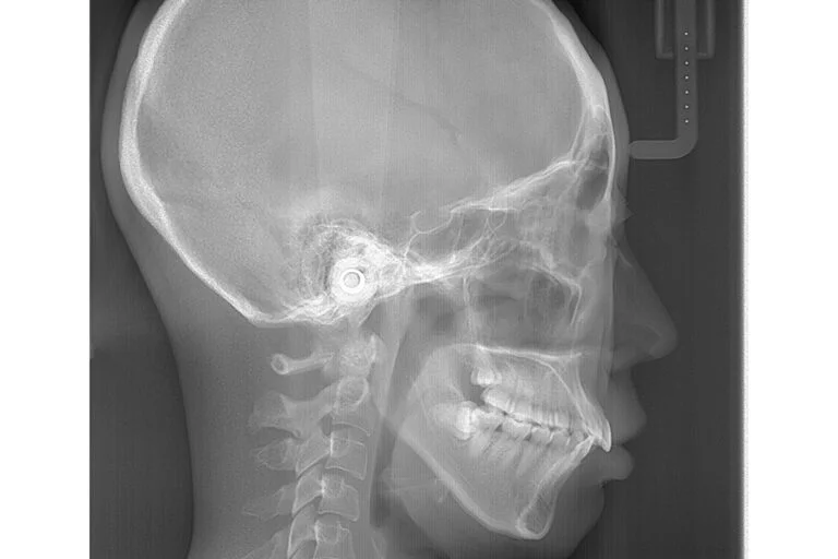 セファログラム